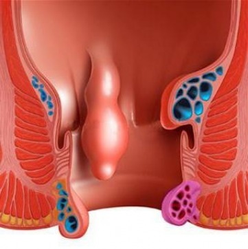 gallery/полип кишки