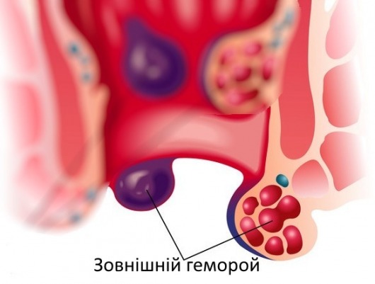 gallery/геморой зовнішній сайт