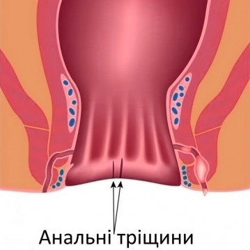 gallery/trishhini-v-zadnomu-prohodi-yak-i-chim-likuvati-analni-trishhini_4562